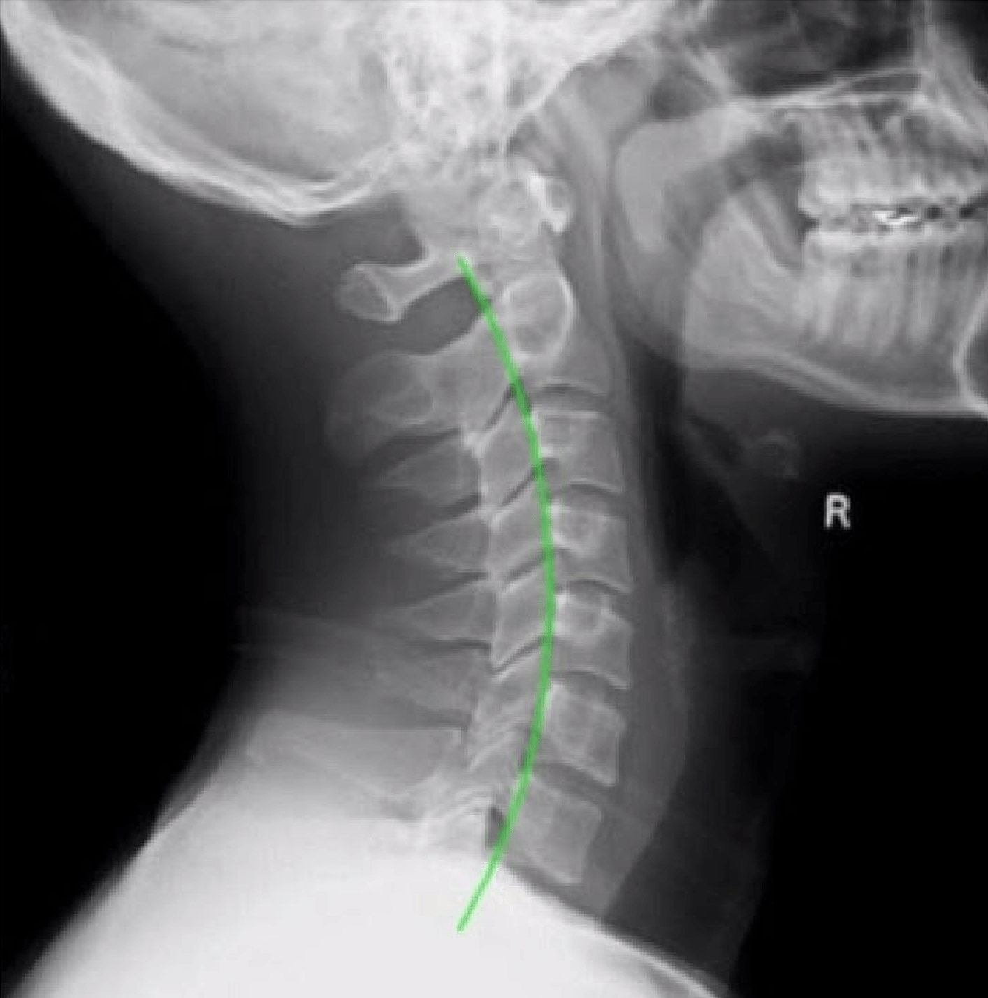 La courbure cervicale, essentielle à notre bienêtre Chiropracteur Tahiti