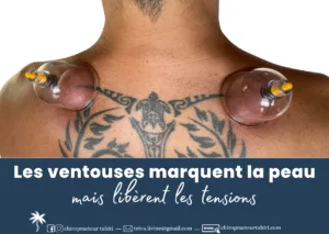 Les ventouses marquent la peau, mais libèrent les tensions