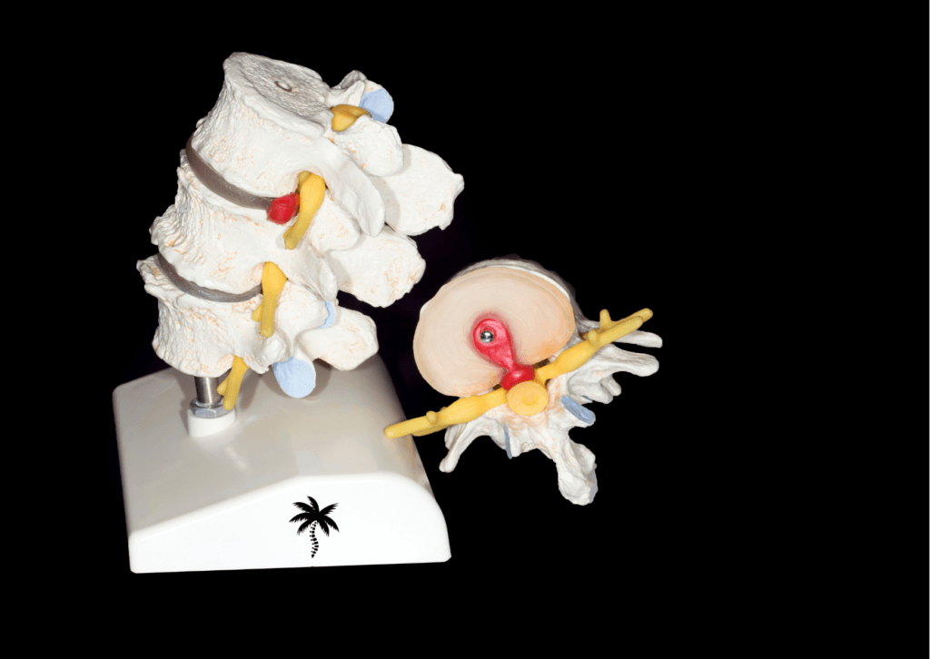 3 idées reçues sur la hernie discale