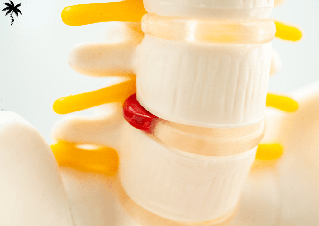 3 idées reçues sur la hernie discale