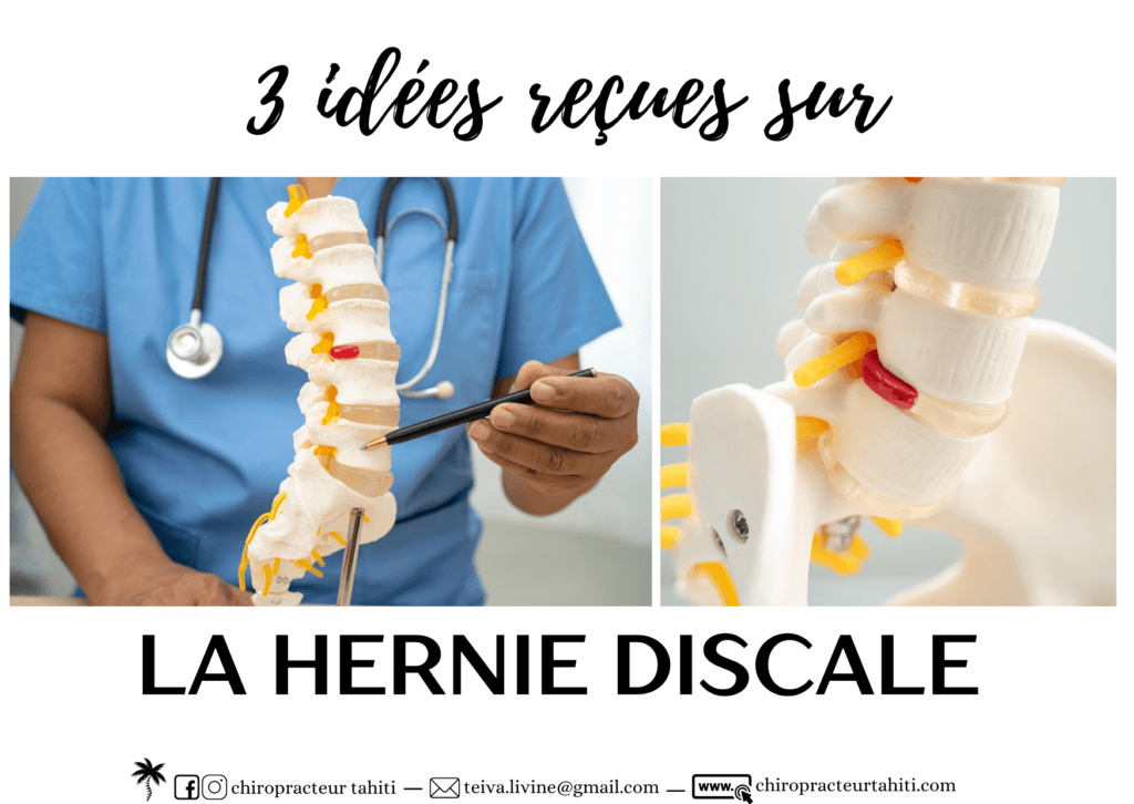 3 idées reçues sur la hernie discale